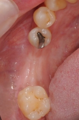 Hamid Ryan Kazemi- Missing Lower Teeth