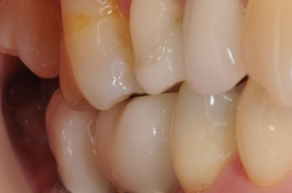 Final crowns on short dental implants