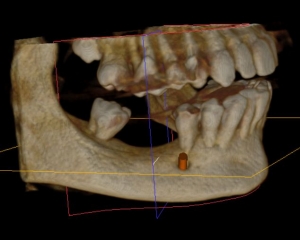 Hamid Ryan Kazemi- CBCT missing molars