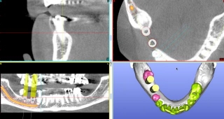 3-D dental implant planning using CBCT