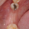 Hamid Ryan Kazemi- Missing Lower Teeth