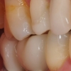 Final crowns on short dental implants