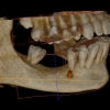 Hamid Ryan Kazemi- CBCT missing molars
