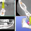 3-D CBCT dental implant planning