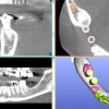 3-D dental implant planning using CBCT