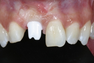 The custom abutment