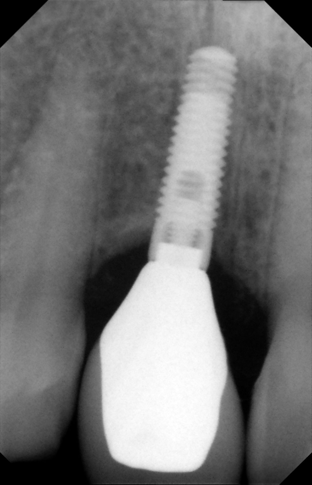 X-ray- dental implant and crown
