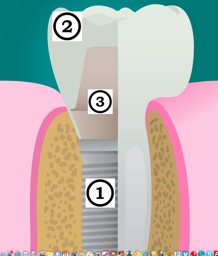 Dental implant, abutment, tooth crown