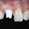 The custom abutment