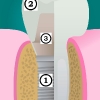 Dental implant, abutment, tooth crown