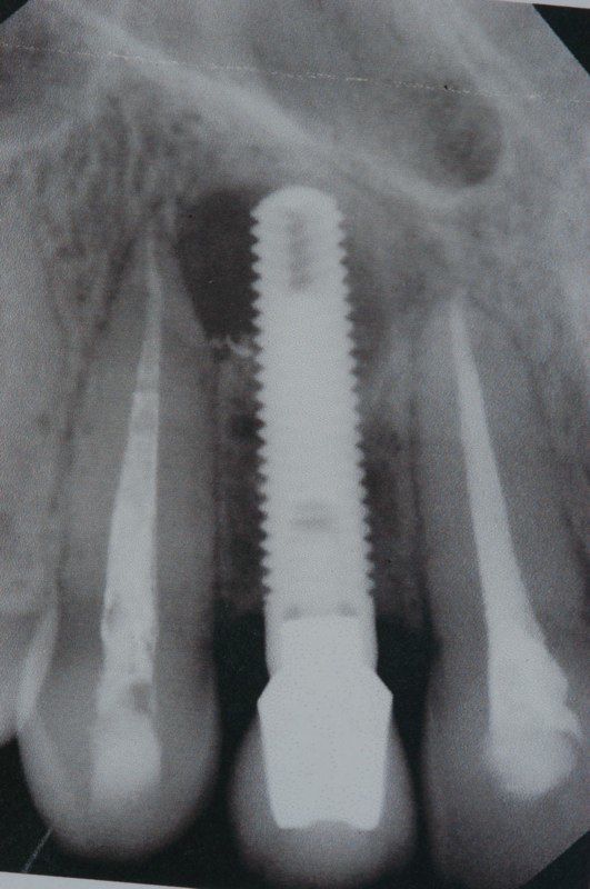 X-ray after endodontic retreatment