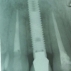 X-ray post operative