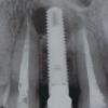 X-ray after endodontic retreatment