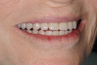 Smile with hybrid prosthesis
