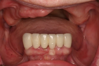 Remaining teeth with missing bone