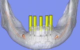 3-D CBCT implant planning