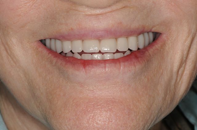 Smile with hybrid prosthesis and proper bite
