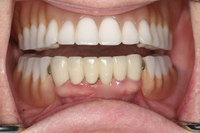 teeth in a day- Patient with remaining lower teeth