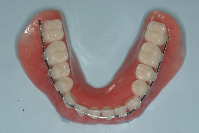 Transitional denture