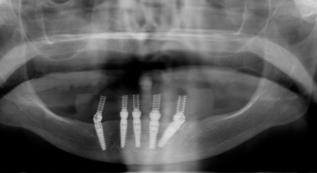 Panorex- dental implants