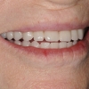 Smile with hybrid prosthesis