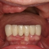 Remaining teeth with missing bone