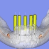 3-D CBCT implant planning