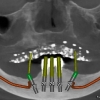 3-D CBCT implant planning