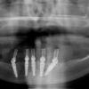 Panorex- dental implants