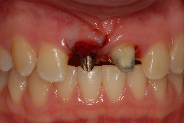 implant supported provisional