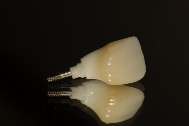 Final restoration for the implant