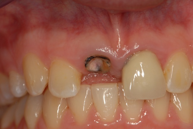Broken incisor crown with decay
