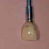 Provisional on implant
