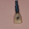 Provisional on implant