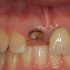 Broken incisor crown with decay