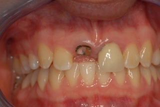 Broken upper incisor tooth