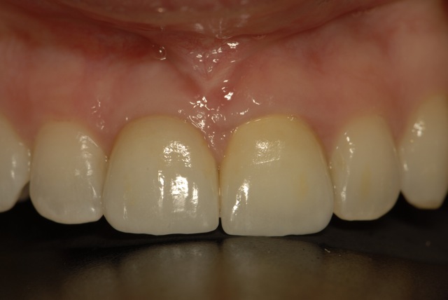 Final crown on dental implant