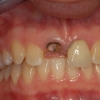 Broken upper incisor tooth