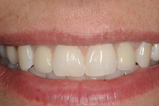 New smile- Final crowns on dental implants
