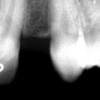 X-ray missing upper lateral incisor #10