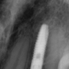 Final X-rays with crowns- #10