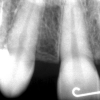 X-ray missing upper lateral incisor #7