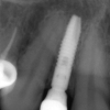 Final X-rays with crowns- #7