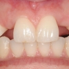 Congenitally Missing upper lateral incisors