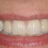 New smile- Final crowns on dental implants