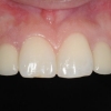 Natural appearance of the new teeth supported by implants