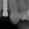 Dental implant placement #10