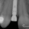Dental implant placement #7