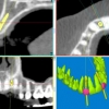 CBCT (dental CT scan)
