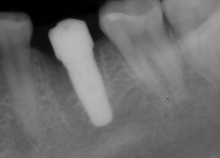 Dental implant placement